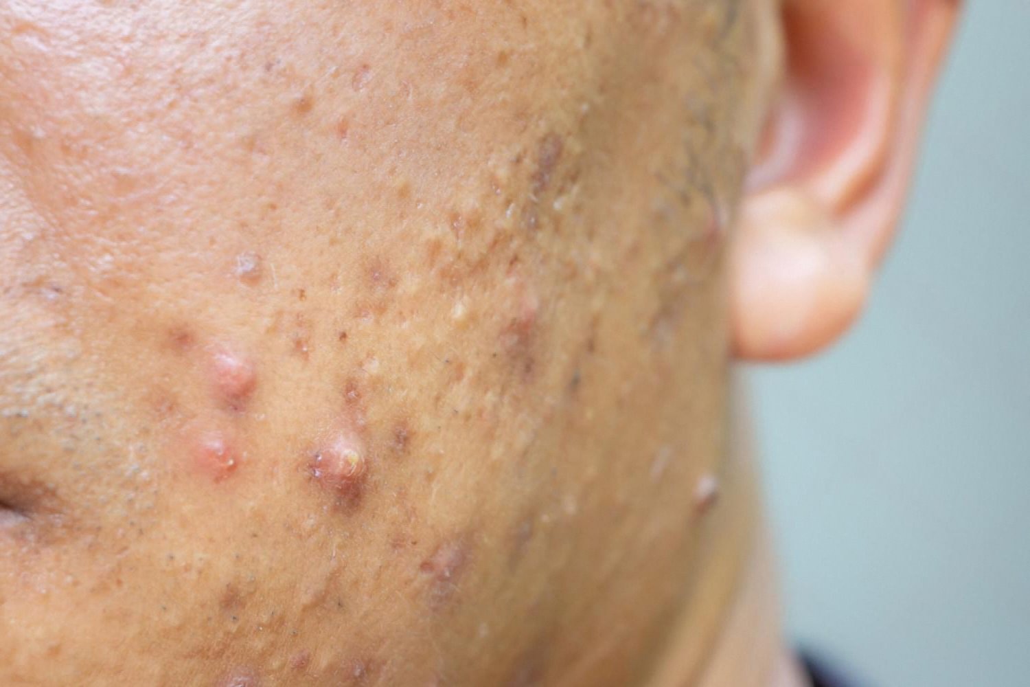 Close-up of adult acne and post-inflammatory marks on cheek skin